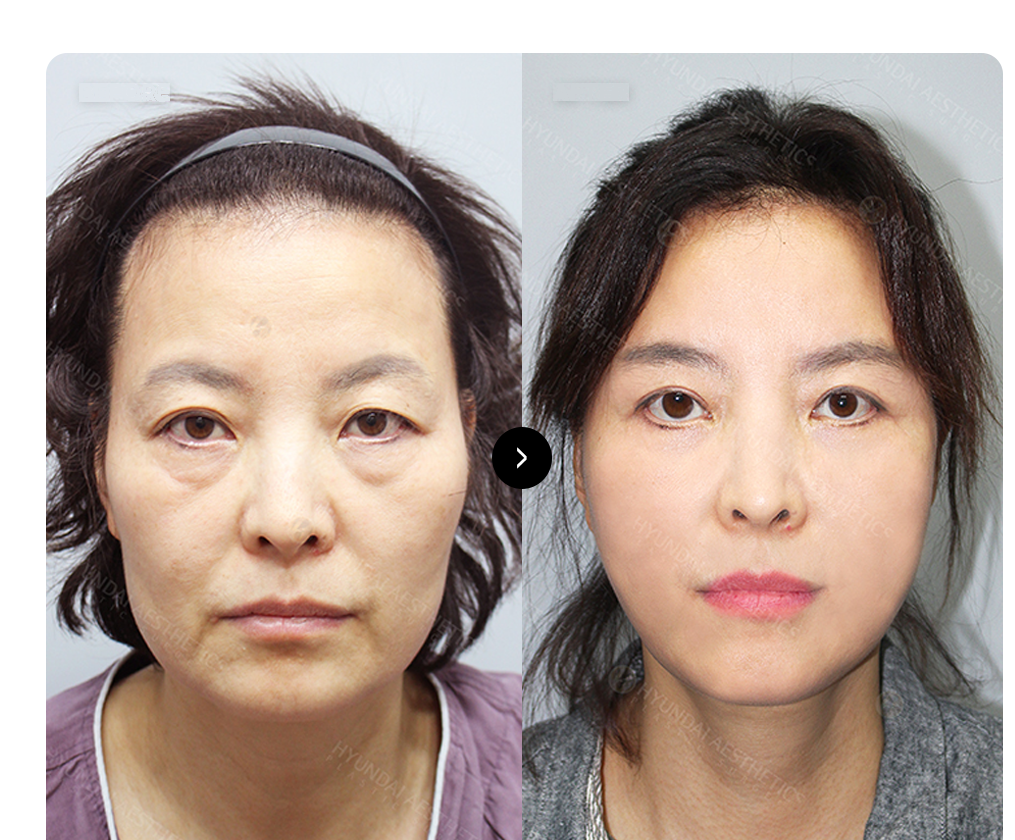 SMAS facelift BEFORE & AFTER — before-and-after surgical comparison