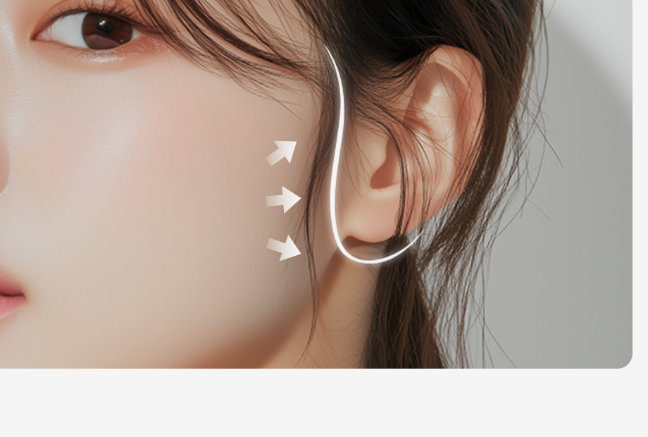 SMAS facelift incision areas — incision designed within the area around the ear