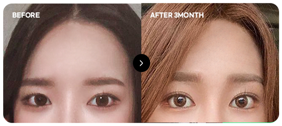 Baby-face forehead lift before and after 1