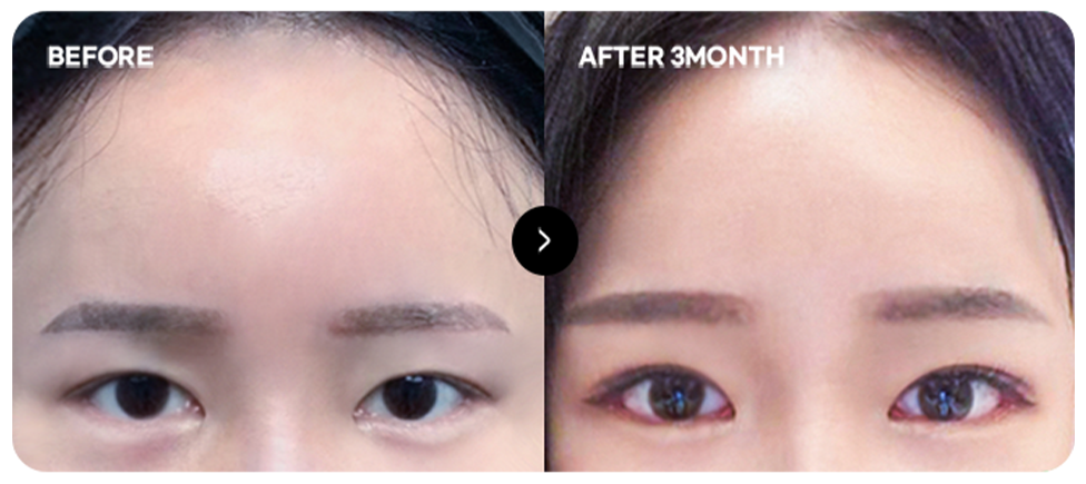 Baby-face forehead lift before and after 2