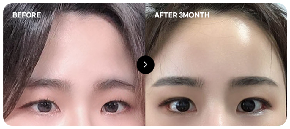 Baby-face forehead lift before and after 4