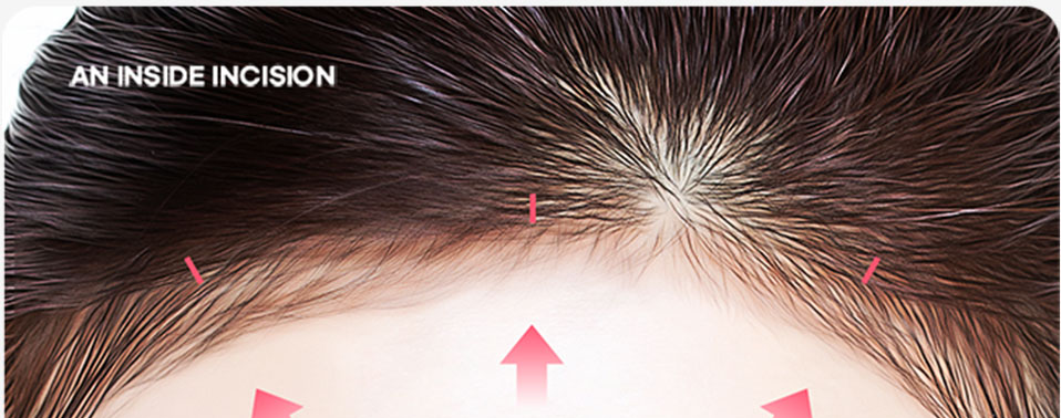 Close-up of the forehead showing the incision area inside the hairline - AN INSIDE INCISION