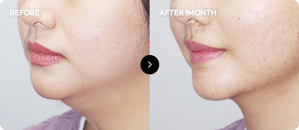 Close-contact thread lifting before and after 1