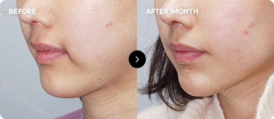 Close-contact thread lifting before and after 2