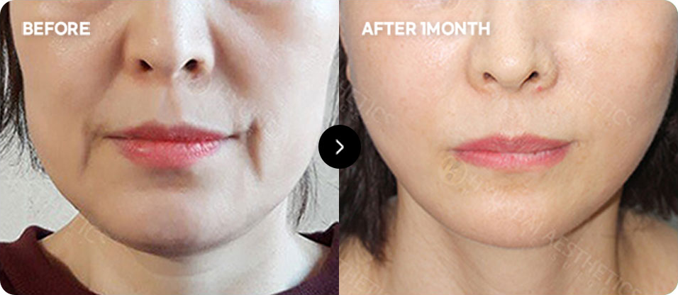 Close-contact thread lifting before and after 3
