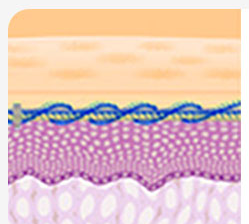 Cross-sectional illustration of lifting thread insertion