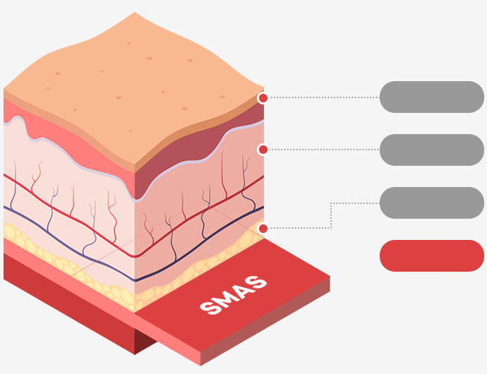 Skin cross-section illustration showing the epidermis, dermis, subcutaneous fat layer, and SMAS layer