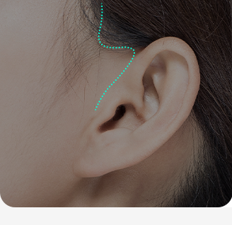 Fine incision line in front of the ear