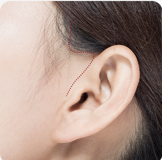 Suturing the incision site — procedure complete
