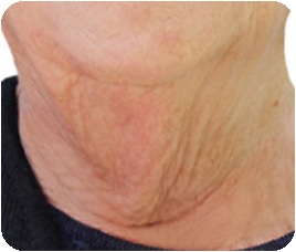 Receding-chin type neck wrinkles - sagging neck with loss of the jaw-neck boundary