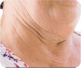Bulldog-type neck wrinkles - neck sagging in layers like a double chin