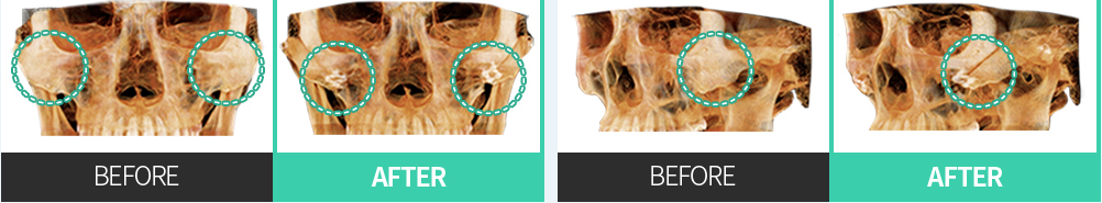CASE 02 Posterior-superior repositioning — frontal and lateral CT BEFORE / AFTER comparison