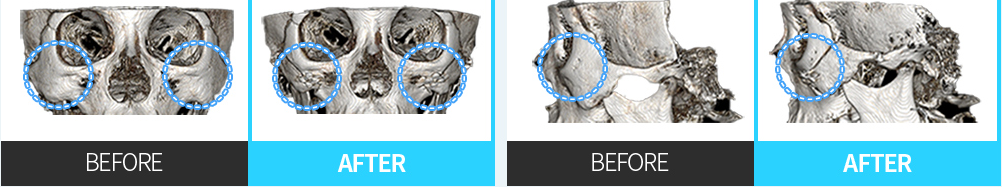 CASE 03 Cheekbone rotation — frontal and lateral CT BEFORE / AFTER comparison