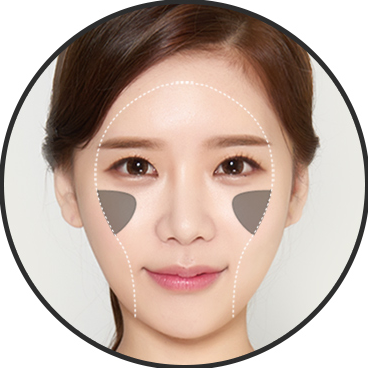 Volume — anterior cheekbone fat grafting + lateral cheekbone reduction