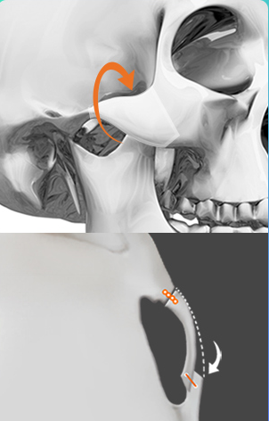 Rotation — cheekbone rotation diagram (frontal and lateral CT)