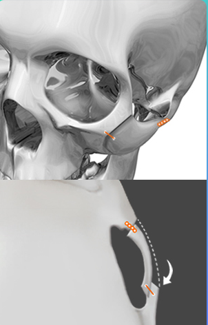 Repositioning — cheekbone posterior-superior repositioning diagram (frontal and lateral CT)