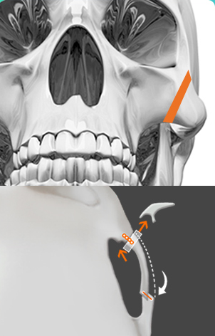 Resection — partial cheekbone resection diagram (frontal and lateral CT)