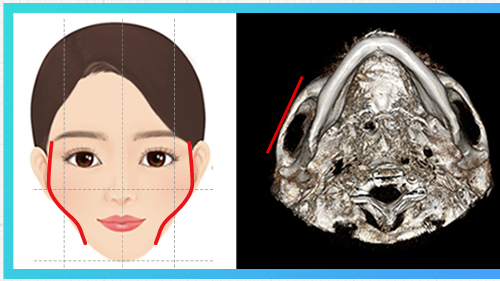 Lateral cheekbone protrusion type — cheekbone diagram + CT