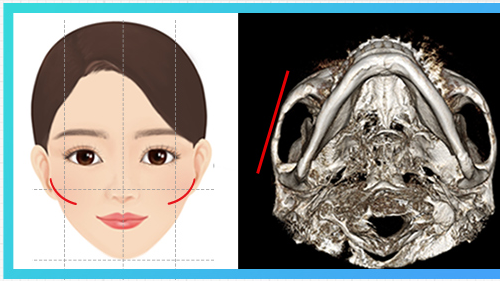 45-degree cheekbone protrusion type — cheekbone diagram + CT