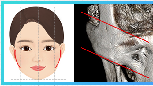 Overall wide cheekbone type — cheekbone diagram + CT