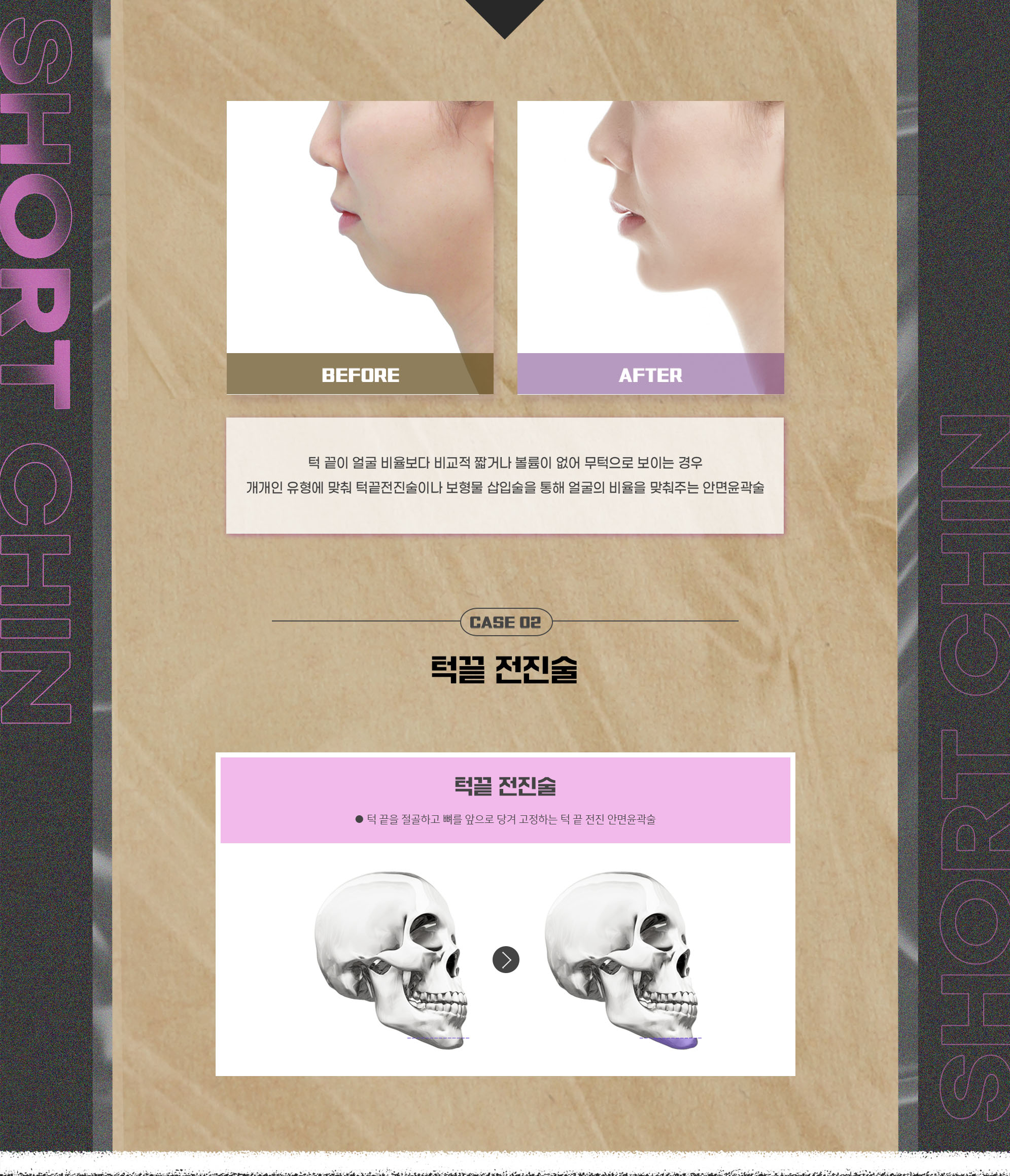 CASE 02 Short chin tip and retruded chin — before-and-after photos and chin advancement procedure
