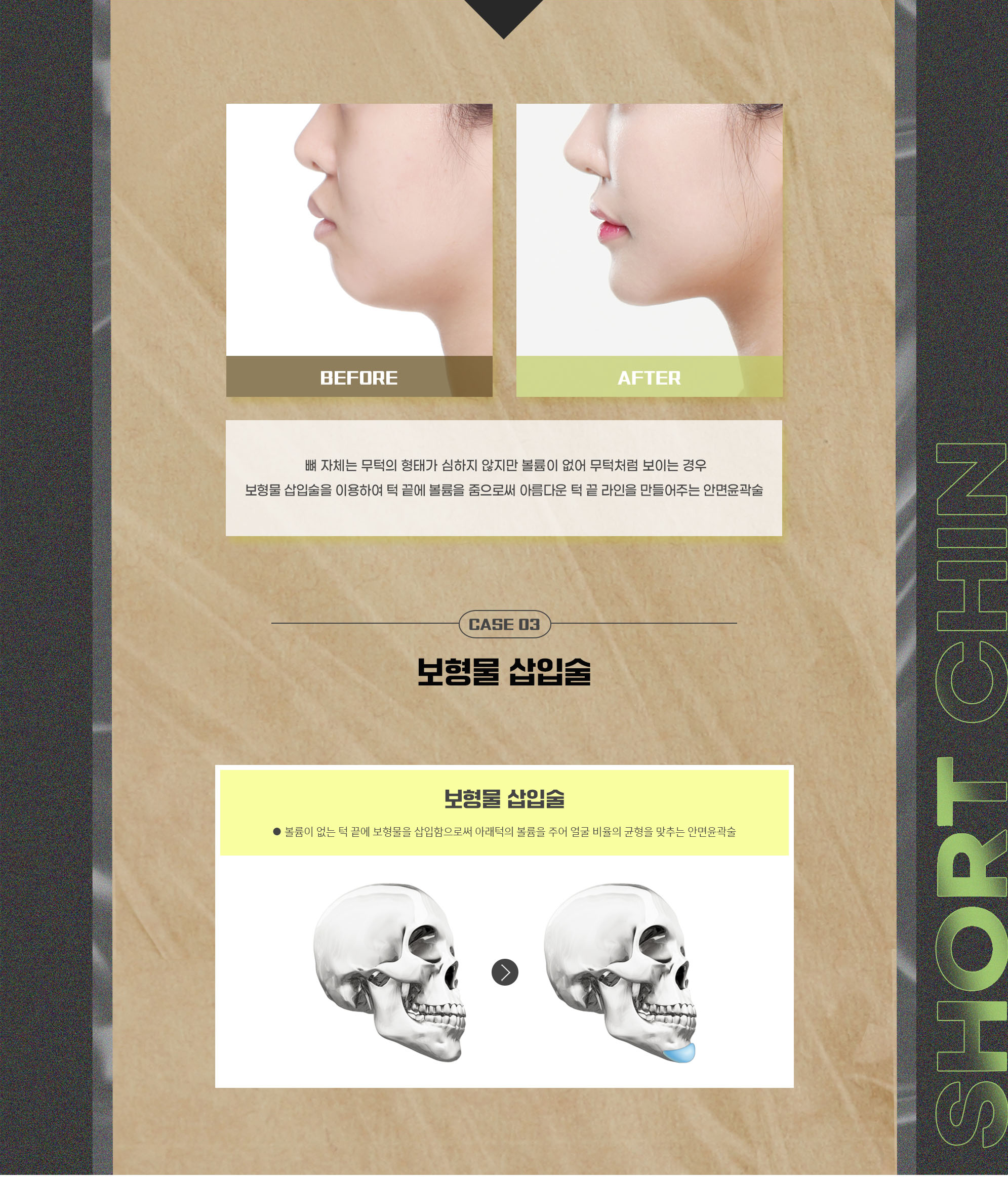 CASE 03 Lack of volume and retruded chin — before-and-after photos and implant insertion procedure