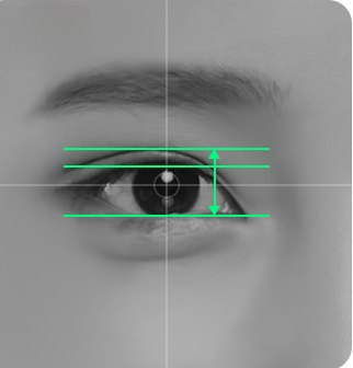 Photo showing correction lines on the eyes after non-incision correction surgery