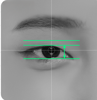 Photo showing correction lines on the eyes before non-incision correction surgery