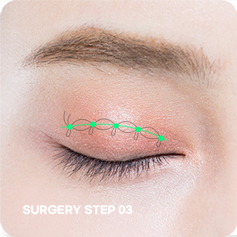 Non-incision correction STEP 03 photo of establishing the surgical plan