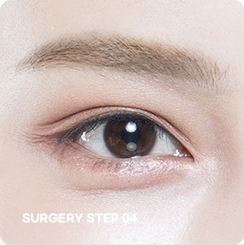 Non-incision correction STEP 04 photo of surgery completion