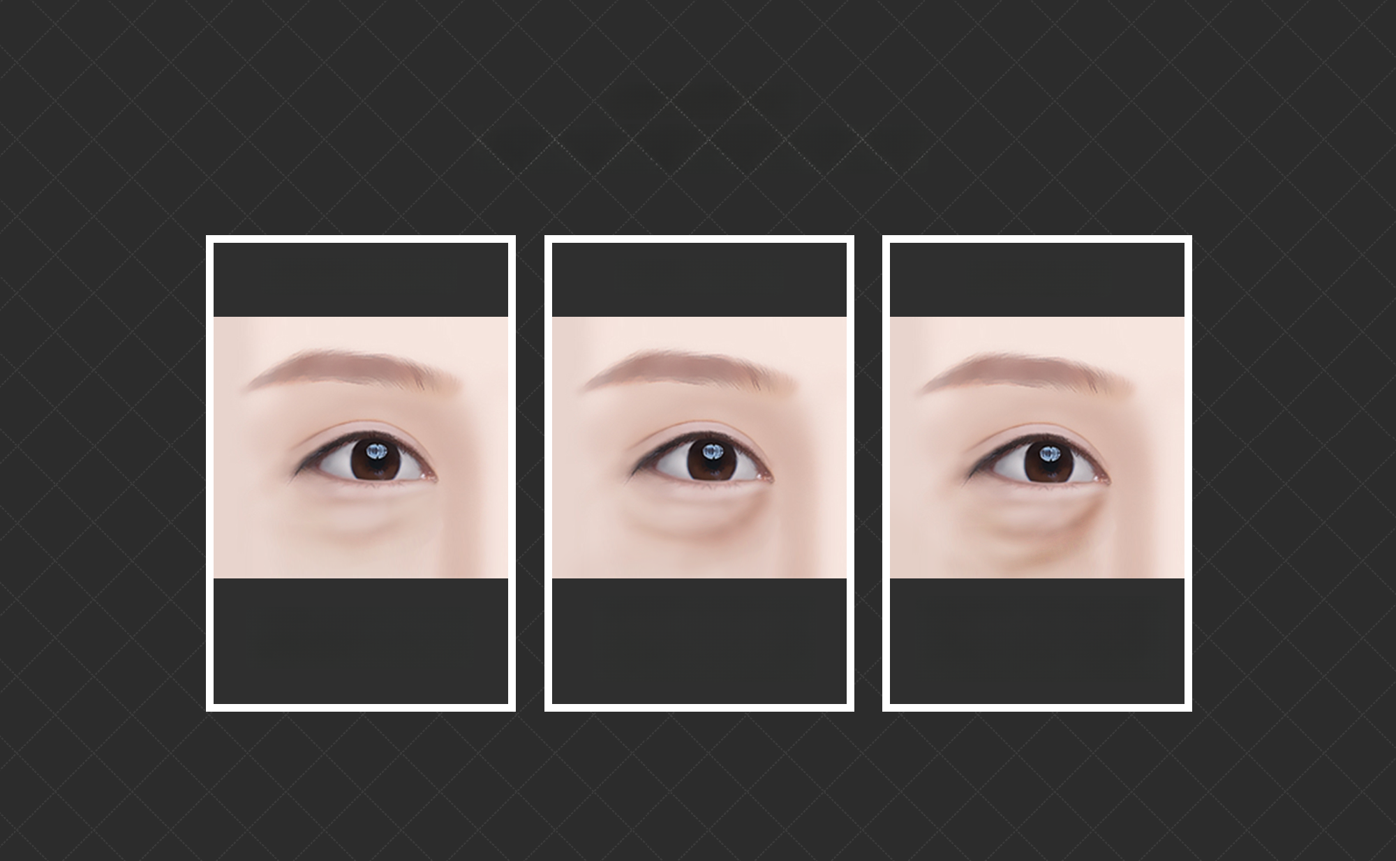 Three before-and-after eye photos comparing lower eyelid surgery according to under-eye fat condition