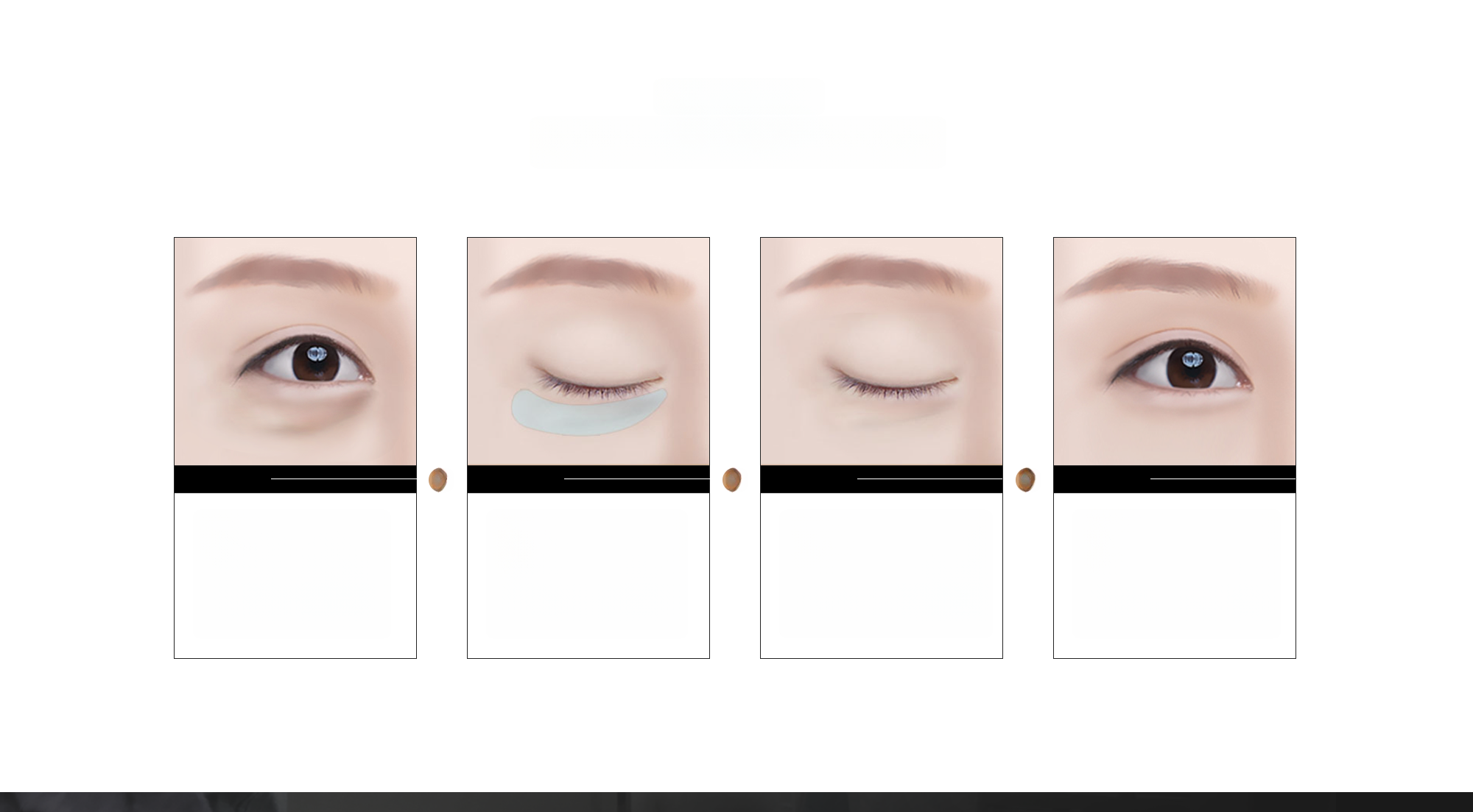 Four eye diagrams showing the 4-step process of lower eyelid surgery