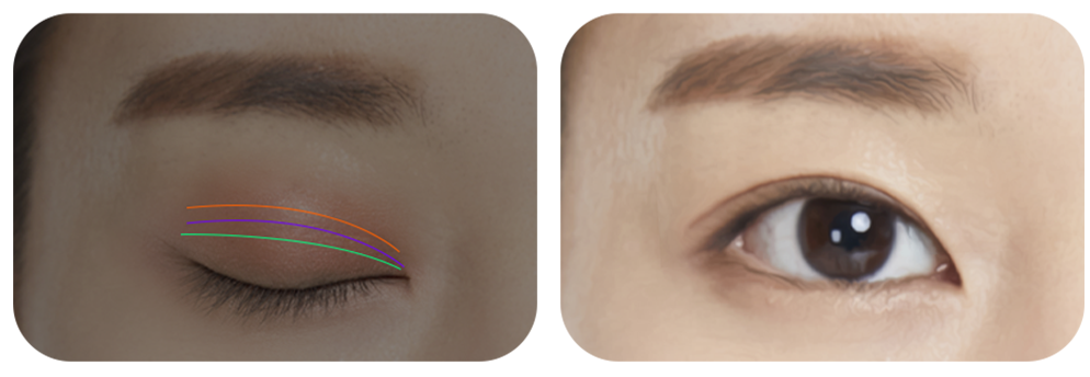 Double-eyelid design issue case