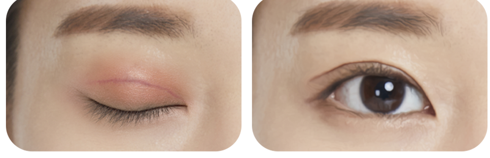 Uneven line caused by scarring case