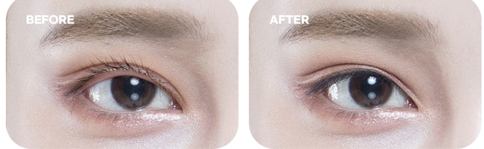 Scars, lifted eyelashes case