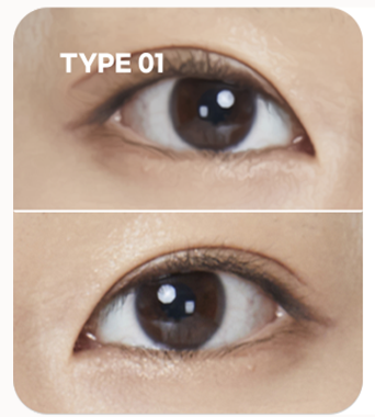 Asymmetric double-eyelid creases case