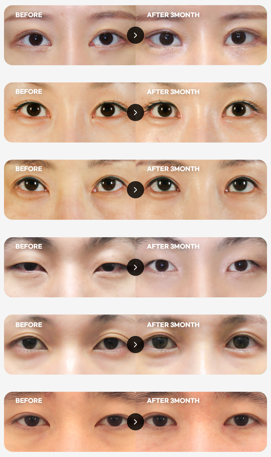 Hyundai Aesthetic Surgery epicanthoplasty restoration BEFORE&AFTER — 6 before-and-after comparisons