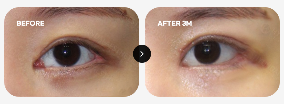 Excessive lacrimal caruncle (red tissue) exposure case