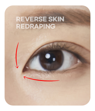 Reverse skin rearrangement illustration