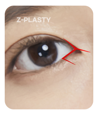 Z-plasty illustration