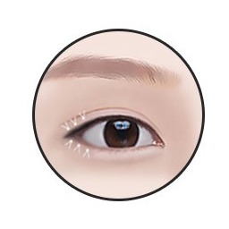 Lower canthoplasty step 3 — scar-concealing suturing