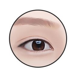 Lower canthoplasty step 4 — soft, defined eyes complete
