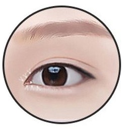 Epicanthoplasty step 4 — completing a natural, open-looking eye shape
