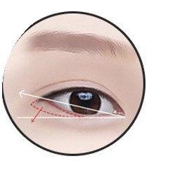 Rear epicanthoplasty step 2 — diagnosis and design of incision length