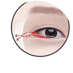 Rear epicanthoplasty step 3 — lateral canthus periosteal fixation
