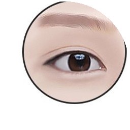 Rear epicanthoplasty step 5 — completed open-looking eyes with extended horizontal length
