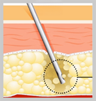 Microcannula insertion — cross-section showing injection into the fat layer