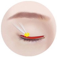 Illustration of STEP 02 excision stage for incision double eyelid surgery