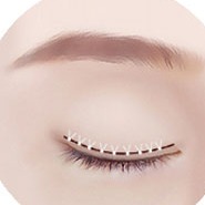 Illustration of STEP 03 fixation and suturing stage for incision double eyelid surgery