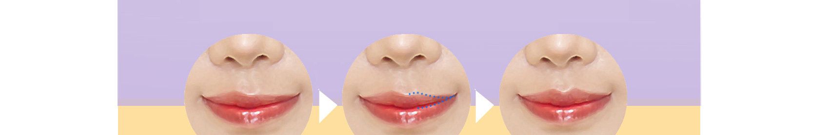 Before and after Cupid's bow / lip line asymmetry correction
